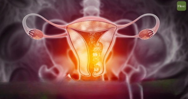 Endometrial cancer has a high cure rate if detected and treated early. (Photo provided by Heho Health)